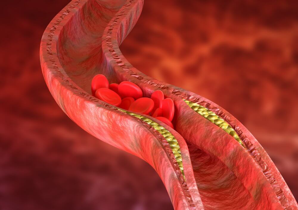 cinta-kinesiologica-aterosclerosis-es-acumulacion-placas-colesterol-paredes-arterias (1) (1)