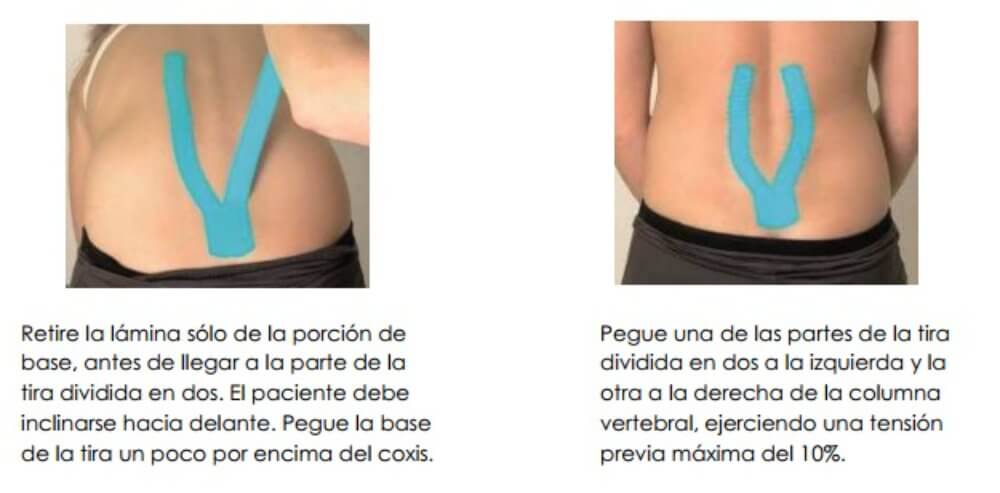 cinta-kinesiologica-kinesiotape_ejemplo_2